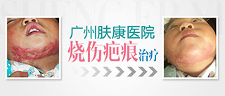 广州肤康皮肤病医院